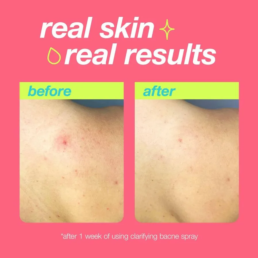 body acne duo