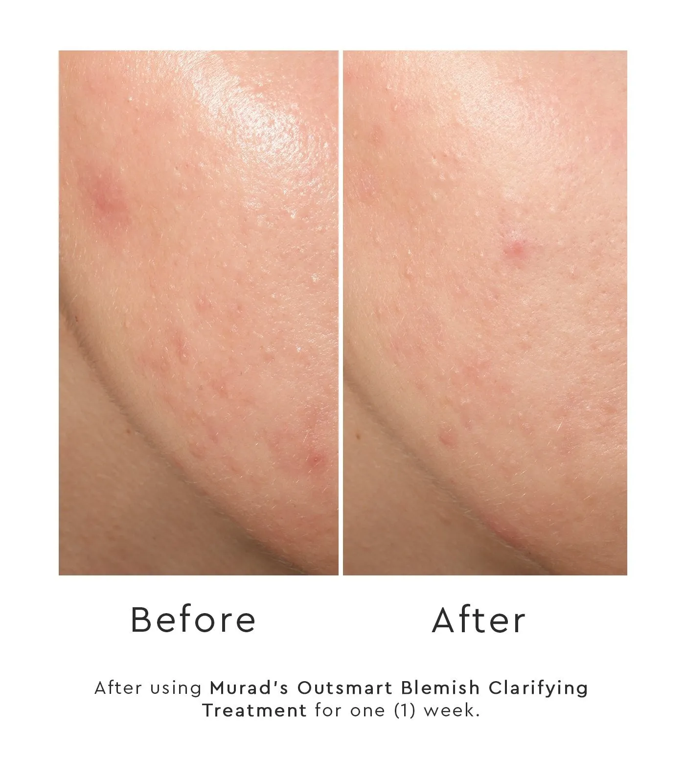 Outsmart Blemish™ Clarifying Treatment